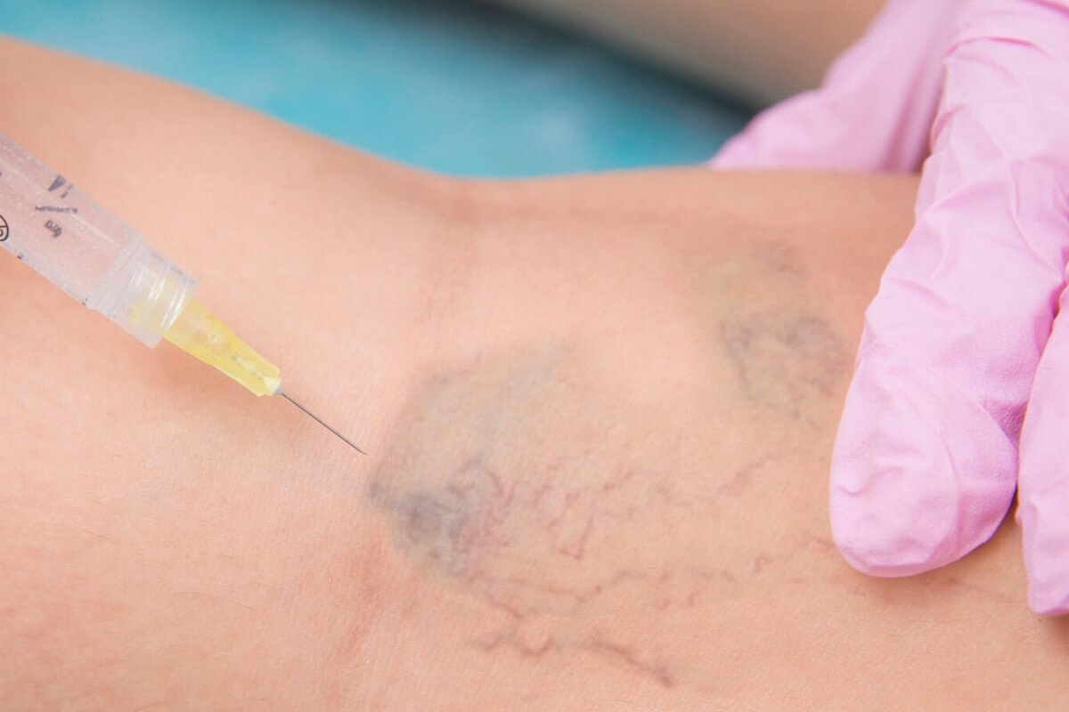 Procedimento estético injetável para microvasos